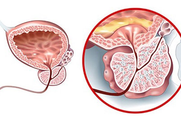 HoLEP Surgery