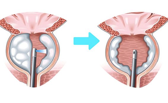 Benefits of HoLEP Surgery