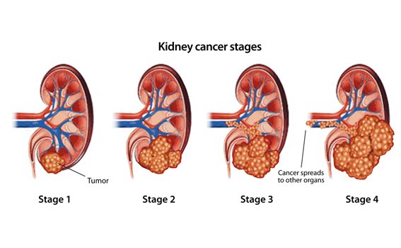 Stages of Kidney Cancer
