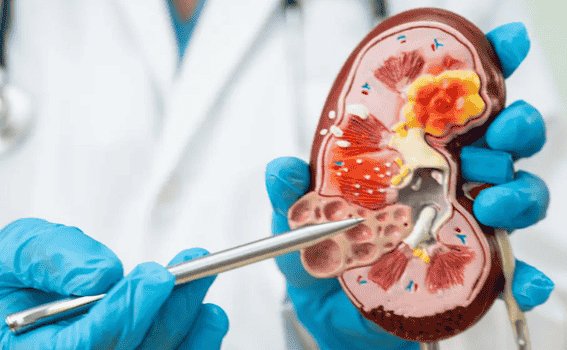 Types of Kidney Transplant