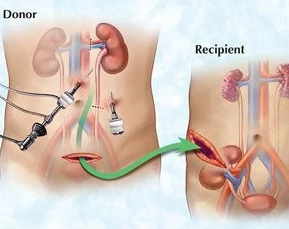 Kidney Transplant Surgery Procedure