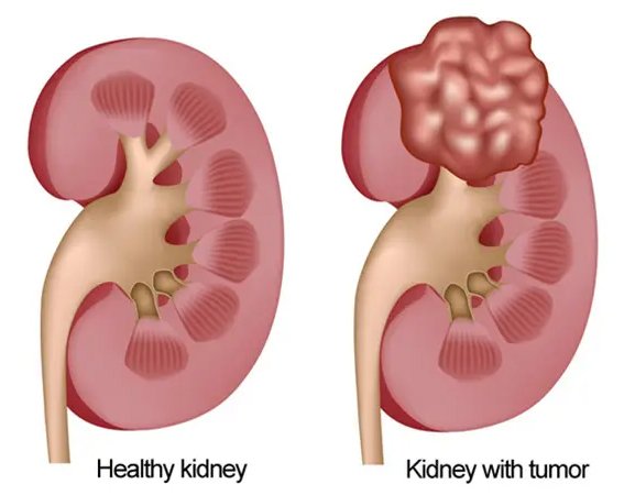 Conditions Treated with Laparoscopic Nephrectomy