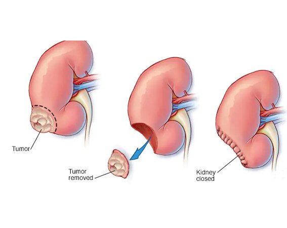 Who Needs Laparoscopic Nephrectomy