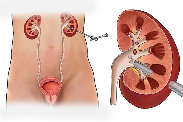 Mini PCNL Surgery