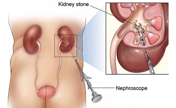 Mini PCNL Procedure