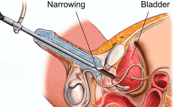 Who Needs OIU / VIU Surgery