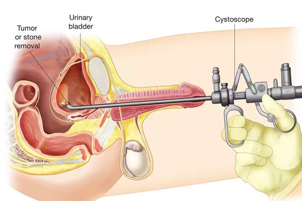 OIU VIU Procedure Steps