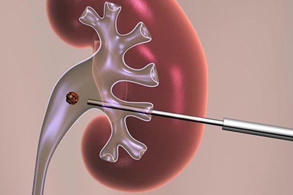 PCNL Surgery