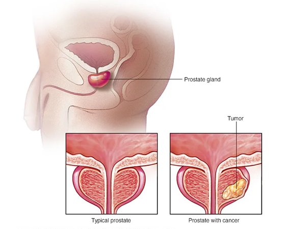 Symptoms of Prostate Cancer