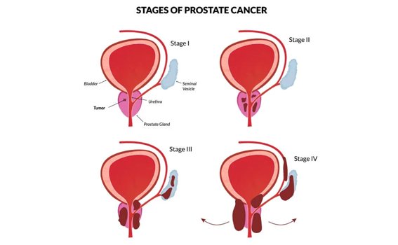 Stages of Prostate Cancer