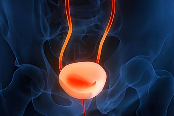 What is Robotic Cystectomy