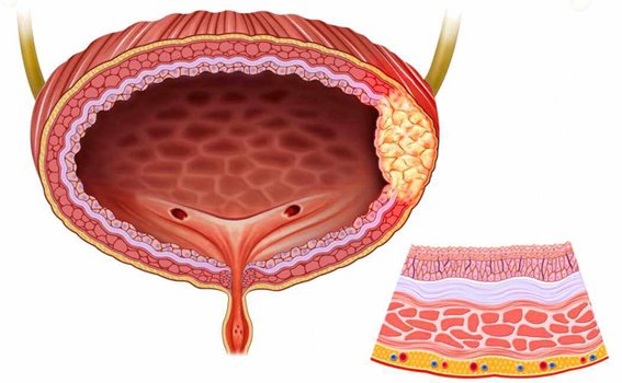 Bladder Cancer