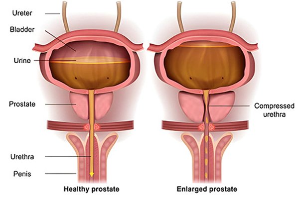 TURP Procedure